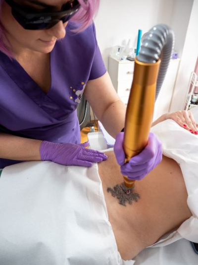 Îndepărtare tatuaj cu laser îndepărtare tatuaj